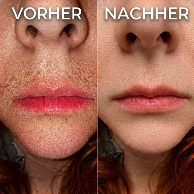Elvion - Håråterväxthämmande serum