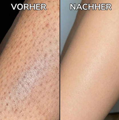 Elvion - Håråterväxthämmande serum